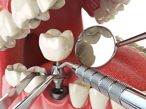Best Emergency Wisdom Tooth Extraction in Elgin, TX